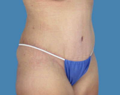 LipoTuck Before & After Patient #984
