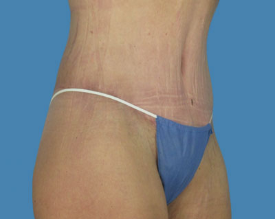 LipoTuck Before & After Patient #985