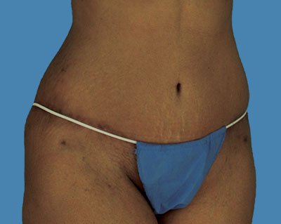 LipoTuck Before & After Patient #1067