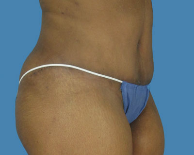 LipoTuck Before & After Patient #986