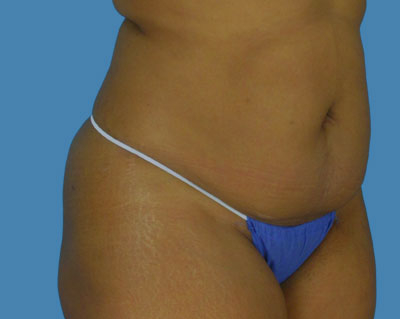 LipoTuck Before & After Patient #988