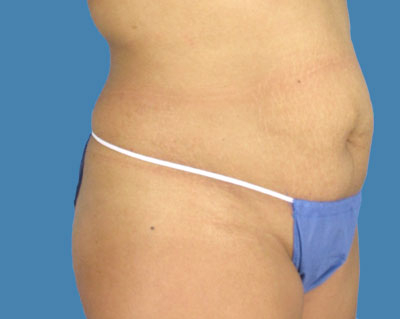 LipoTuck Before & After Patient #990