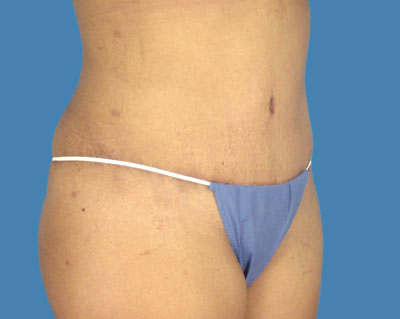 LipoTuck Before & After Patient #990