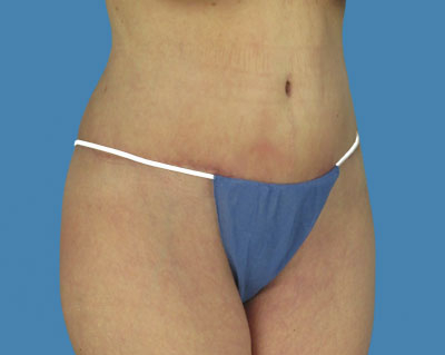 LipoTuck Before & After Patient #991