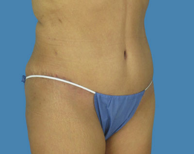 LipoTuck Before & After Patient #992