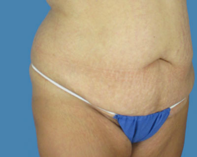 LipoTuck Before & After Patient #993