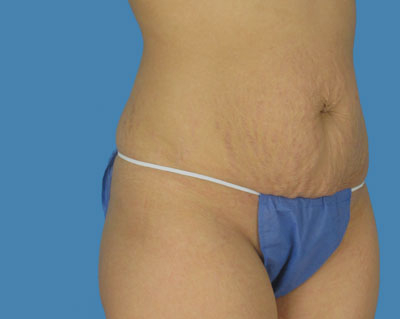 LipoTuck Before & After Patient #994