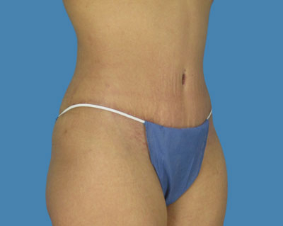 LipoTuck Before & After Patient #994