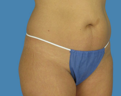LipoTuck Before & After Patient #996