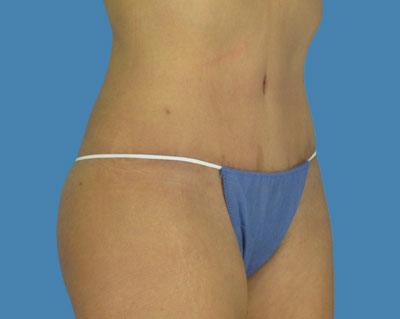 LipoTuck Before & After Patient #996