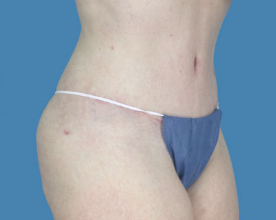 Lipotuck Before & After Patient #1002