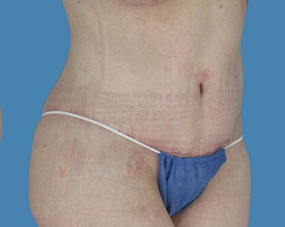 LipoTuck Before & After Patient #1068