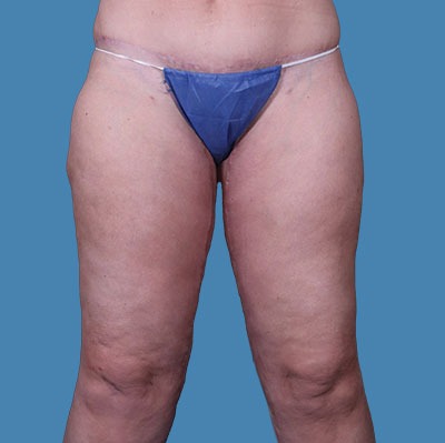 Thigh Lift Before & After Patient #1155
