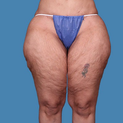 Thigh Lift Before & After Patient #1156