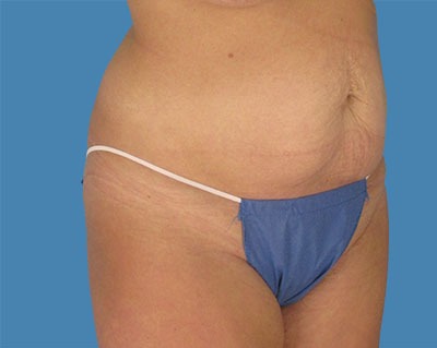 Tummy Tuck Before & After Patient #911