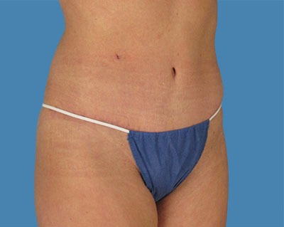 Tummy Tuck Before & After Patient #911