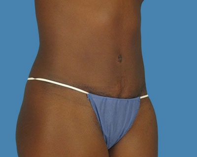 Tummy Tuck Before & After Patient #912