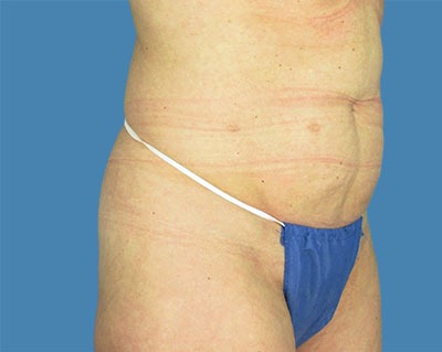Tummy Tuck Before & After Patient #913
