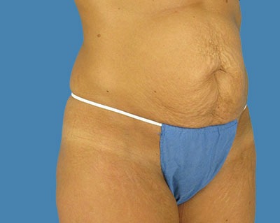Tummy Tuck Before & After Patient #914