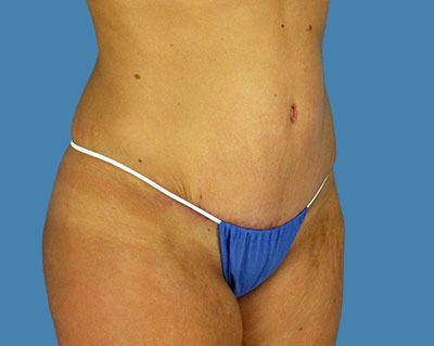 Tummy Tuck Before & After Patient #914