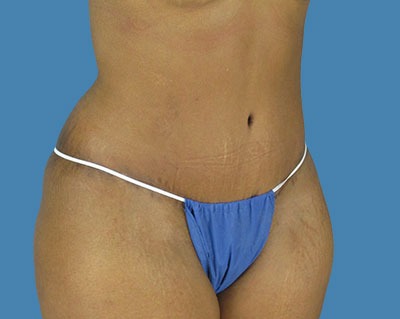 Tummy Tuck Before & After Patient #915
