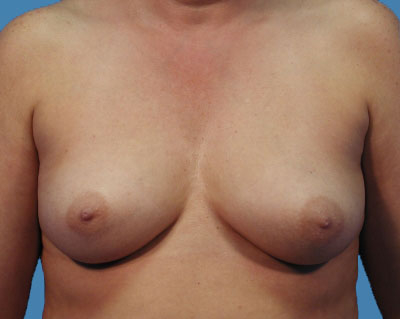 Breast Augmentation Before & After Patient #1107