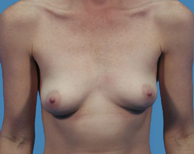 Breast Augmentation Before & After Patient #1109