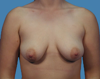 Breast Augmentation Before & After Patient #1114
