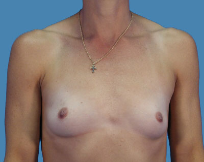 Breast Augmentation Before & After Patient #1087