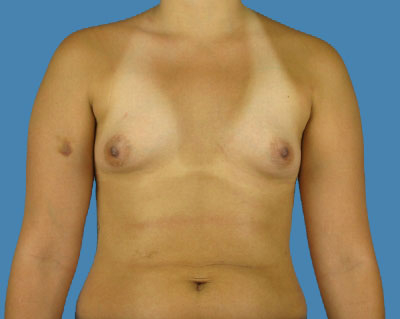 Breast Augmentation Before & After Patient #1117