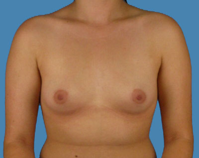 Breast Augmentation Before & After Patient #1083