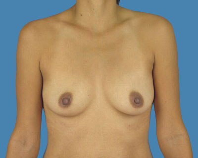 Breast Augmentation Before & After Patient #1096