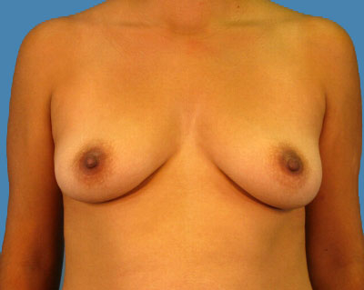 Breast Augmentation Before & After Patient #1098