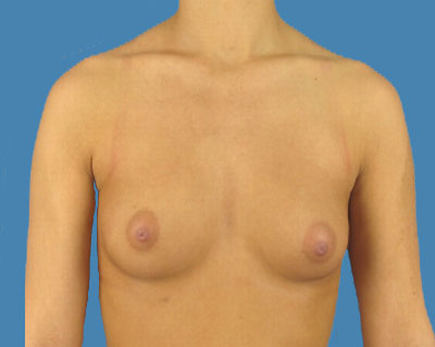 Breast Augmentation Before & After Patient #1102