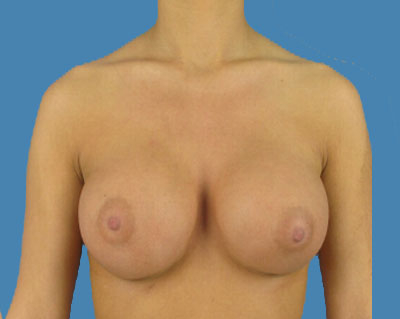 Breast Augmentation Before & After Patient #1102