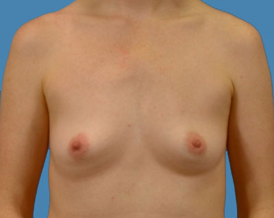 Breast Augmentation Before & After Patient #1111
