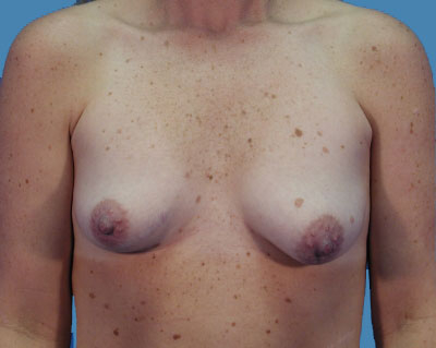 Breast Augmentation Before & After Patient #1091