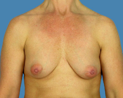 Breast Augmentation Before & After Patient #1142