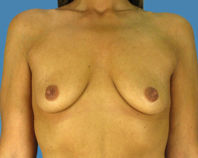 Breast Augmentation Before & After Patient #1144