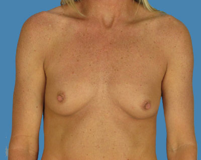Breast Augmentation Before & After Patient #1150