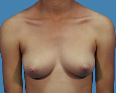 Breast Augmentation Before & After Patient #1093