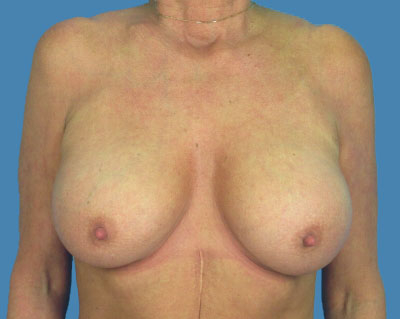 Breast Augmentation Before & After Patient #1154