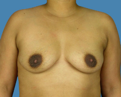 Breast Augmentation Before & After Patient #1170