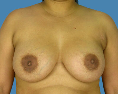 Breast Augmentation Before & After Patient #1170