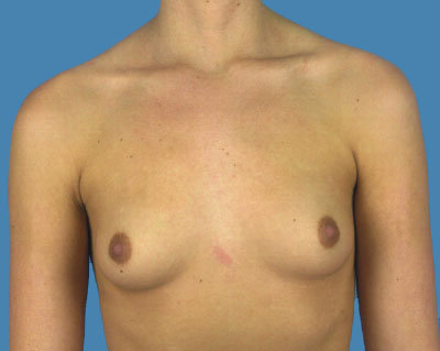 Breast Augmentation Before & After Patient #1172