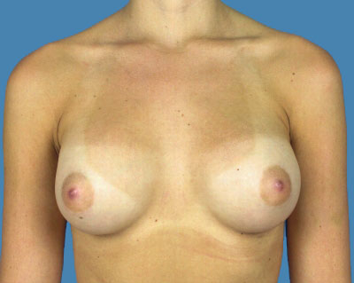 Breast Augmentation Before & After Patient #1172