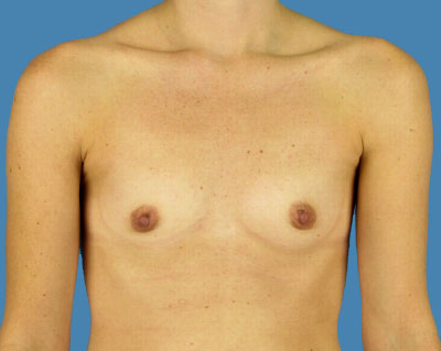 Breast Augmentation Before & After Patient #1179