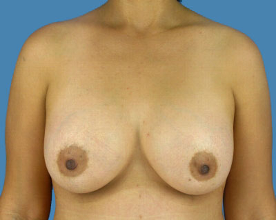 Breast Augmentation Before & After Patient #1174