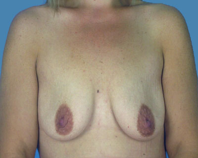 Breast Augmentation Before & After Patient #1176