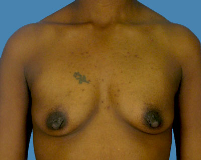 Breast Augmentation Before & After Patient #1177